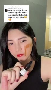 Serum Mụn Beskin Herbal Chính Hãng 5ml