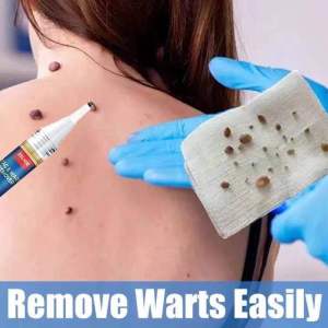 EELHOE SKIN TAG WART REMOVER mole remover corn remover penanggal ketuat kutil tahi lalat bintik hitam
