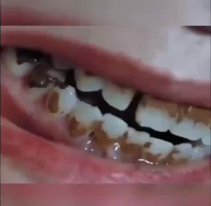 Pasta Gigi Pemutih Probiotik SP-6 Menghilangkan Karang Gigi Kuning dan Mengobati Bau Mulut Menyegarkan Udara Rasa Mint Meningkatkan Kesehatan Gusi Menghilangkan Plak dan Mencegah Kerusakan Gigi 120g