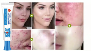 Effective Remove Pimples Quickly Pimple Remover Fades Marks Repairs Acne Pits Facial Scar Care Shrink Pores Anti Aging Whitening Collagen Glutathione Pores Treatment Blackheads Acne Scars Pimples Quick Acne Removal Cream 25g