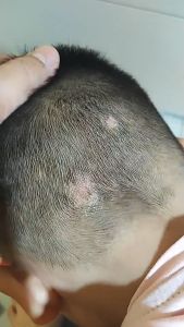 Seborrheic dermatitis cream Scalp treatment Scalp psoriasis ubat gatal kulit Folliculitis hair follicle acne health care cream Remover Acne Anti Itching cream 止癢毛囊炎