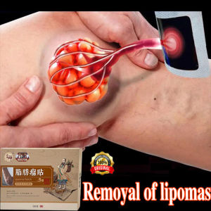 Original Lipoma Removal Stickers Lipoma Patch Special Removing Multiple Single Lipoma Subcutaneous Lipoma Lump Bulge Cured Lipoma Removal Patch Lipoma Removal Patch lipoma removal cream skin swelling ointment Body Health Care Medical Plaster Eliminates