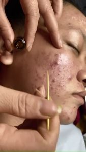 Combo TCA Chấm nám tàn nhang & Kem phục hồi da chống tăng sắc tố Loại bỏ các hắc tố đen nám tàn nhang căng bóng Handmade