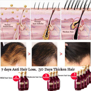 Moist People™【500ML】anti hair loss treatment hair growth shampoo for women natural organic hair growth shampoo and conditioner ginger anti dandruff shampoo shampoo for hair growth for women ginger shampoo hair loss long hair fast growth shampoo for men