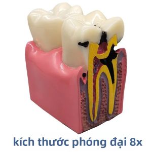 Mô Hình Sâu Răng 8x Bằng Nhựa Resin Dụng Cụ Dạy Học Cho Nha Sĩ Phòng Thí Nghiệm Nghiên Cứu Răng Miệng Mô Hình Nha Khoa