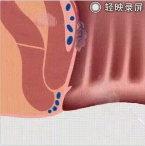 EFFECTIVE EELHOE Natural Herbal Hemorrhoids Spray Original GAMOT sa Almoranas Treatment Hemoclear Almoranas cure ointment almo care hemorhoids spray anal hemorroid cream hemoroids remover No Pain reliever Shrink Swollen