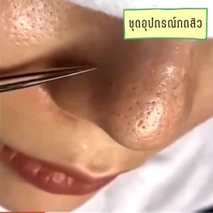 ที่กดสิว ชุดกดสิว ไม้สแตนเลสกดสิว กดสิว สิวหัวดำ สิวอุดตัน สิวเสี้ยน อุปกรณ์กดสิว กำจัดสิวเสี้ยน พกพาสะดวก Acne tool beauties