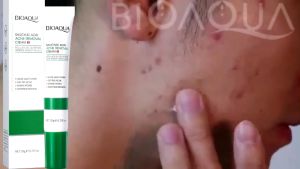 BUY 1 TAKE 1 Salicylic Acid Refreshing Scrub Cleanser Acne Removing Cream Repair Set Oil Control Acne Treatment Deeply Cleansing Exfoliates