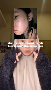 PRM Luxury Paket Skincare Acne Tahap 2 – Atasi Jerawat Sampai Tuntas & Cegah Berulang – Formula Lama BPOM
