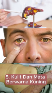 Obat Herbal Liver Hepatitis A B C Asli Manjur Libaver Bharata