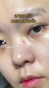 【จัดส่งวันนี้】เจลแต้มสิวชับบี้ Chubby Tea Tree Acne Gel สูตรใหม่ สารสกัด X2 สิวแห้งไว สิวยุบ 10g.