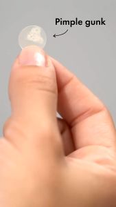 Stiker Jerawat Acne Friendly: Solusi Mengobati dan Menutupi Jerawat