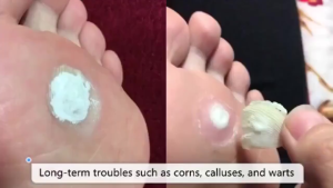 ✨SG STOCK✨Japan Medicated Corn Patch 12PCS Foot Corn Remover Callus Removal Caps Painless Soft Hard Skin Treatment Foot Care Plaster