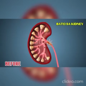 Buy one get one free/Sambong Kidney Cleanser Gummies Canada – Detox Kidney Reduce Nocturia & Kidney Stones (60 gummies)