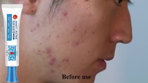 Brightening Acne Cream Facial Repair Dilute Acne Marks Remove 100% Skin Pimples Products 亮白祛痘霜面部修复淡化痘印去除100%皮肤痘痘产品
