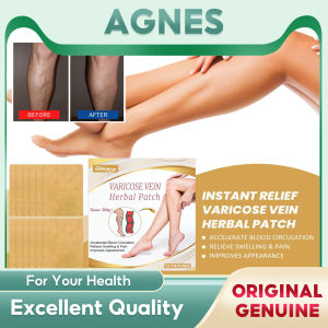 Hot Sale: South Moon Varicose Vein Patch & Earthworm Legs Unblock