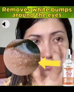 Fat granule remover Eye cream Eye removing magic device to remove fat particles Syringoma eye surrounding small granulation miliaria papule essence 30ml 脂肪粒去除 Milia Remover Essential Oil Eyes Fat Granules Removal Serum Anti-Aging Moisturiz