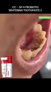 Probiotic Toothpaste SP-4 - Repair Cavities Whiten Teeth & Remove Plaque Original SP-4 Ultra Whitening Toothpaste for Fresh Breath Dazzling White Toothpaste | For All Oral Concerns