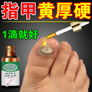 Yellow Thickened Nail Fungus Treatment Tool Toe Nail Yellowing Hardening Yellow Nail Cap Bad Nail Good Nail Medicine