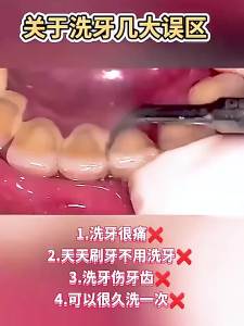 Konka Ultrasonic Frequency Wave Dental Calculus Remover Dental Cleaner Ultrasonic Calculus Remover Dental Cleaning Device