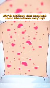 QUARXERY Mite & Acne Cleansing Body Wash: A Comprehensive Guide