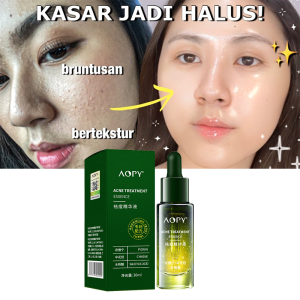 Acne Essence 30ml Salicylic Acid Anti-acne Serum Lighten Acne Scars Acne