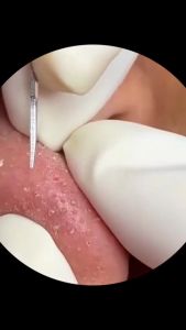 Termurah!! Alat Pembersih Komedo Jerawat 7 In 1 Pencabut Komedo Pemencet Jerawat Stainless Steel