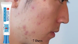 Facial Care Salicylic Acid Acne Cream: Blackhead & Oil Control Anti-Acne Fades Acne Scars & Brightens Skin Krim Jerawat Asid Salisilik Penjagaan Wajah: Mengawal Minyak & Liang Pori Anti-Jerawat Memudarkan Parut Jerawat & Mencerahkan Kulit