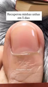 Fast-Acting Hydrogel Nail Repair Patches Powerful 8-Hour Nighttime Care 21-Pack To Repair Damaged And Brittle Toenails Suitable For Sensitive Skin