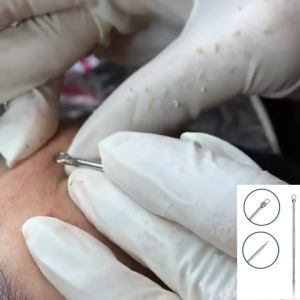 [ CHÍNH HÃNG] Cây nặn mụn Thép không gỉ 2 đầu nặn mụn chuyên nghiệp an toàn dễ dàng nặn mụn