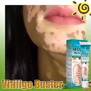 Japan Genuine Vitiligo Cream Vitiligo Skin Treatment Cream Vitiligo Remover White Spot Removal Cream Vitiligo Cream