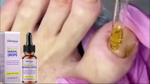 Fungal Nail Repair Drops Infection Nail Removal Anti Paronychia Improve Broken Cracked Discolored Toenail Renewal Care Essence