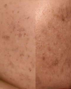 DrCeutics  ALPHA  ARBUTIN 5% + KOJIC DIPALMITATE 2% DEPIGMENTING SERUM 40g - Sáng da ngừa nám