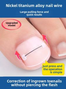 Nickel Titanium Alloy Elastic Steel Wire Corrector for Ingrown Toenails Foot Nail Care Tool Personal Hygiene Kit Foot Care