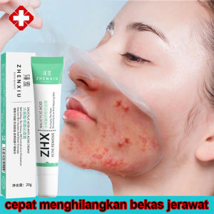 Krim Penghilang Jerawat Herbal Krim Penghilang Jerawat Krim Perawatan Kulit Pemutih Gel Wajah Pelembap Kontrol Minyak Jerawat