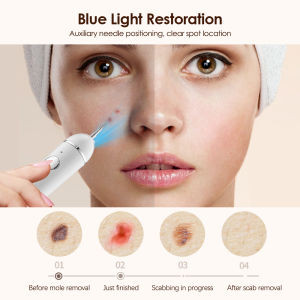 Romyse Mole Remove Pen 9 Gear with Blue Light Plasma Freckle Black Mole Warts Granulation Tattoo Remove Beauty Tools