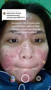 Kapsida Obat Pembersih Darah Kotor Penghilang Gatal Kulit Seluruh Badan Pria Dan Wanita Permanen