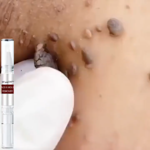 Warts remover original Mole remover Skin tag remover Removal freckle and melanin spots