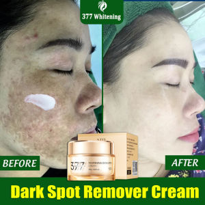 Niacinamide Freckle Remover Cream 377 美白祛斑霜 30g Dark Spot Remover Melasma Cream Freckle Removal Fast Remove All Spots Brightening The Skin