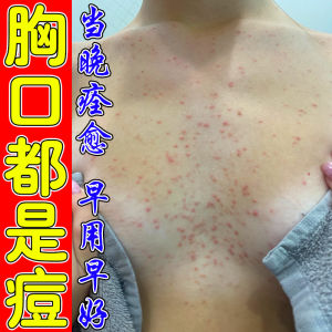 Kem Chống Nấm Lưng Trước Và Sau Kem Chống Nấm Ẩm Kem Dưỡng Ẩm Cho Lưng Và Ngực Thương Hiệu Xianfuji