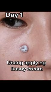 Natures Miracle Kasoy Cream Original Wart Removal Skin Tag Remover Warts Remover Original  4.7  6.9K ratings 10K+ Sold