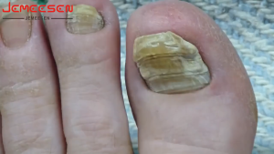 Removal Paronychia Relieves Swelling Pain Fungal Nail Treatment Liquid Toenail Treatment Nail Repair