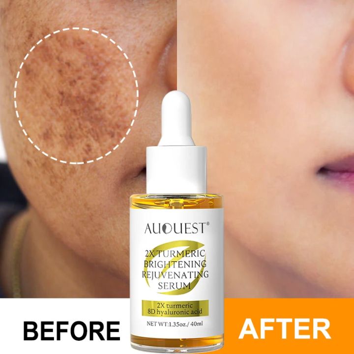 Turmeric Dark Spot Remover Face Serum Freckle Removal Pigment Lighten Collagen Hyaluronic Acid