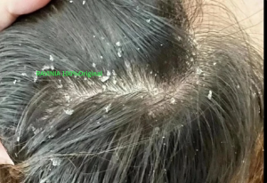 RAVINIA Anti - Dandruff and Oil - Control Shampoo scalp shampoo Dandruff Psoriasis itchy scalp oil control Scalp treatment extract 头皮素