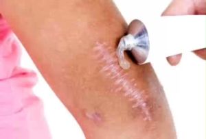 Kem Làm Mờ Vết Rạn Da Và Xóa Tan Các Vết Sẹo Lồi Lâu Năm Giúp Da Trắng Sáng 15g