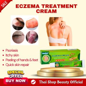 Eczema treatment cream solve skin problems like dermatitis ringworm fungal infection and psoriasis herbal ointment 20g