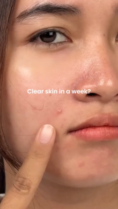 YOU Radiance Plus Acne Brightening Serum 20ml