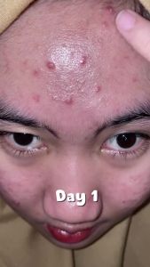 REGLOW SKINCARE - Reglow Acne Spot Gel Double Action Kulit Sensitif Membantu Perawatan Kulit Berjerawat Meradang dan Beruntusan Tanpa Noda Hitam