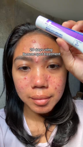 Benzac Acne Care For Pimples & Breakouts Oil Control Clogged Pores Redness Skin Care