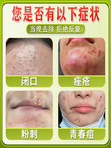 Acne Fighting Cream Face Scar Removal Childrens Chin Recurring Pimple Medicine Cream Gentle Cleansing Anti-acne Facial Cream